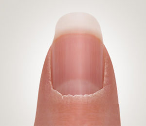 trockene_nagelhaut_haut